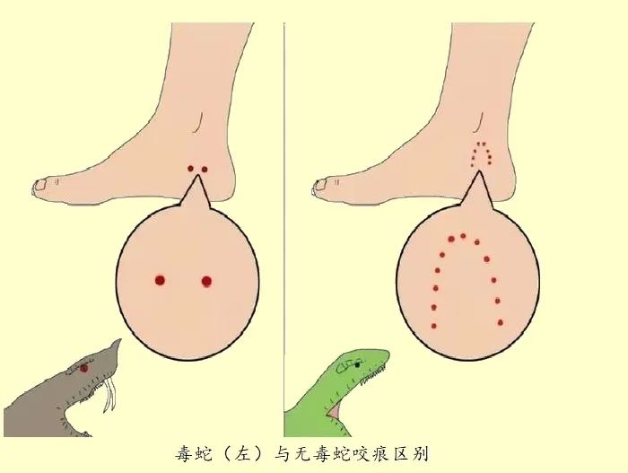 毒蛇与无毒蛇牙痕对比