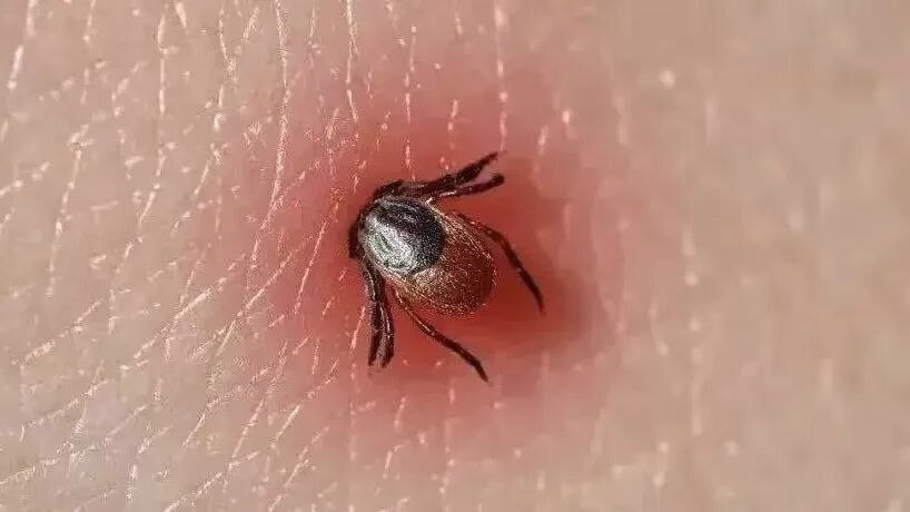 蜱虫叮咬皮肤